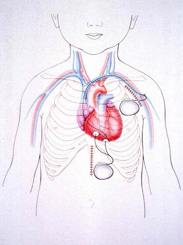 Herzschrittmacher Kind - Kinderkardiologische Gemeinschaftspraxis